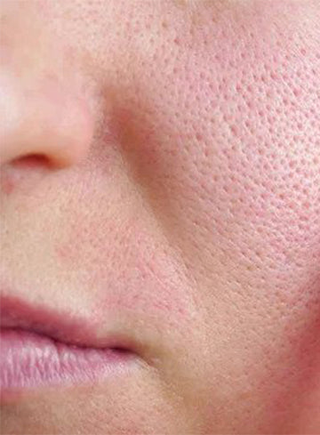 How to get rid of open pores Easily and Naturally