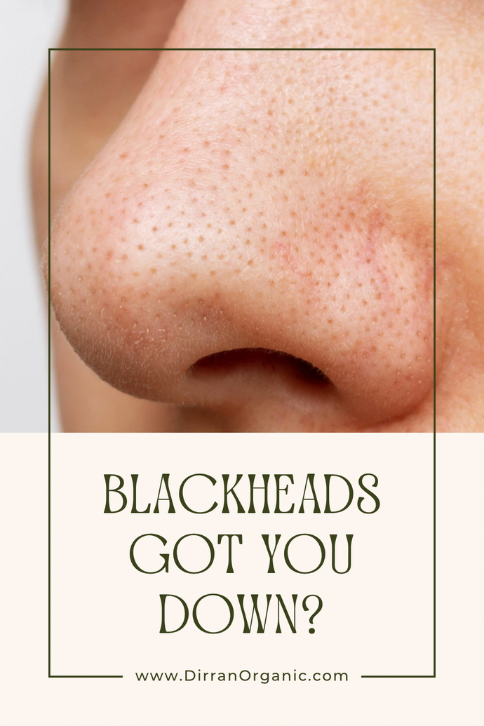 Blackheads Got You Down? Learn How to Get Rid of Them Naturally