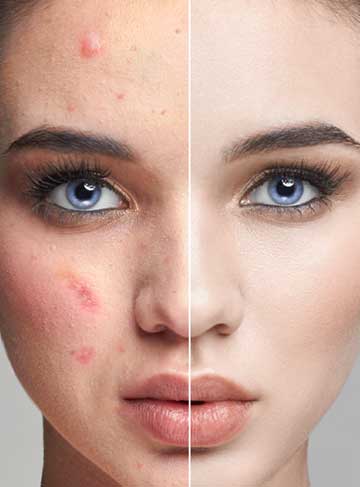 Targeting Acne and Oil Control Means Finding the Right Solution!